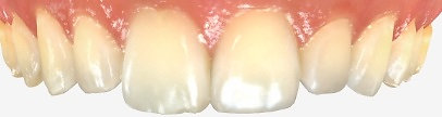 Lateral incisors before composite bonding