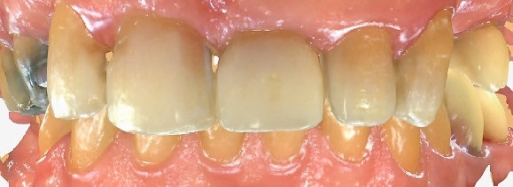 Teeth after composite bonding for severe wear