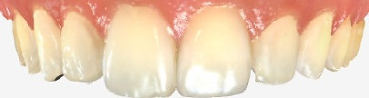 Lateral incisors after composite bonding