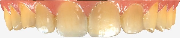 Teeth after composite bonding for moderate wear