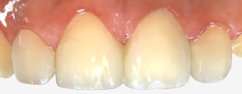 Teeth after composite bonding closed spaces from limited orthodontics