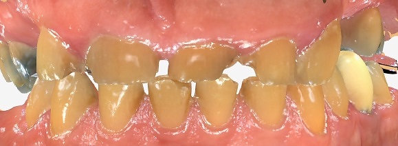 Teeth before composite bonding for severe wear