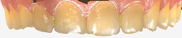 Teeth before composite bonding for moderate wear