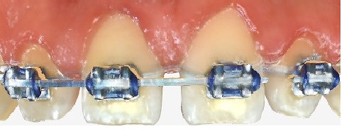 Teeth before composite bonding closed spaces from limited orthodontics