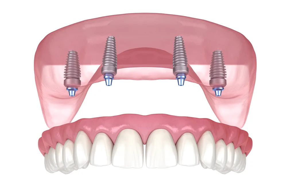 Illustration of four dental implants supporting a full arch of replacement teeth