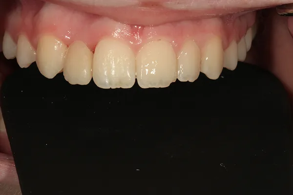 Upper front teeth after treatment, with an even, balanced smile line