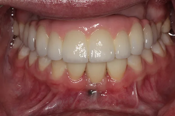Open mouth after treatment, with a full set of upper teeth and restored lower teeth