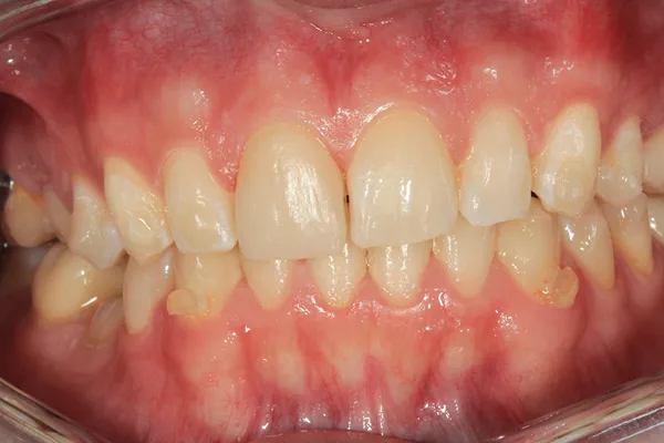 Upper and lower teeth after treatment, with the front teeth aligned