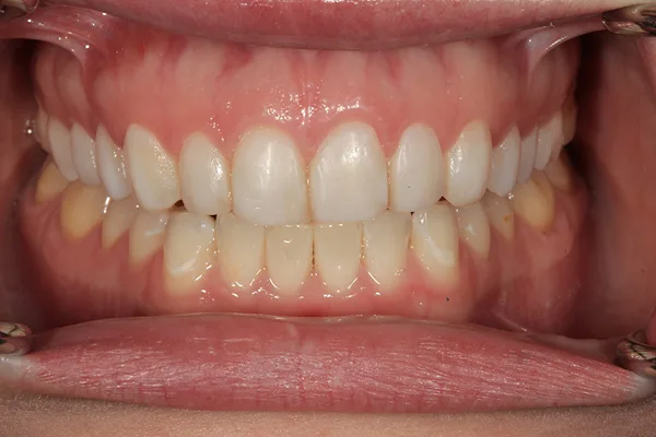 Front view of the teeth in a full smile after treatment, with whiter, more even teeth