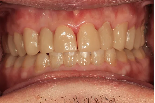 Front view of teeth restored to full length and shape after treatment