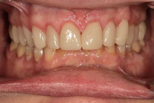Front view of the upper teeth after treatment, with new, brighter, evenly shaped teeth