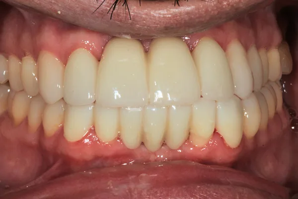 Front view of a complete, even set of teeth after treatment