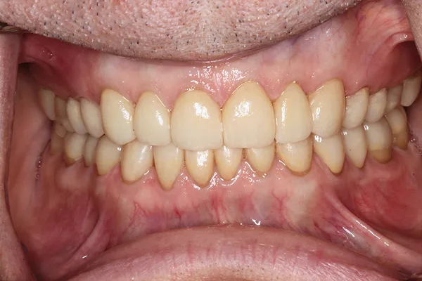 Front view of restored, evenly shaped teeth after treatment