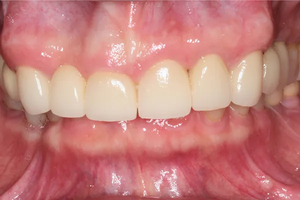 Front view of restored, evenly shaped upper teeth after treatment