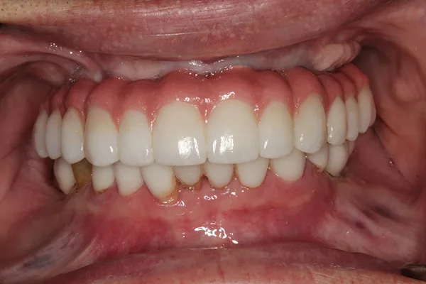 Open mouth after treatment, with a full set of upper and lower teeth