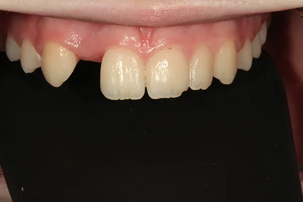 Upper front teeth before treatment, with a gap and a smaller tooth on the left