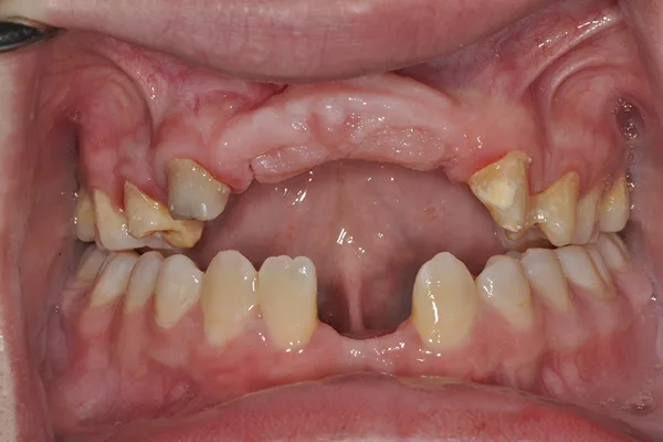 Open mouth before treatment, with many missing upper and lower teeth