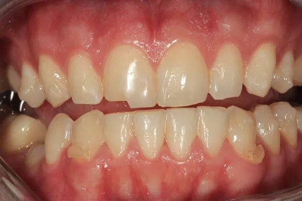 Upper and lower teeth before treatment, with a deep overlap of the front teeth