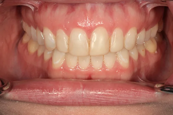 Front view of the teeth in a full smile before treatment