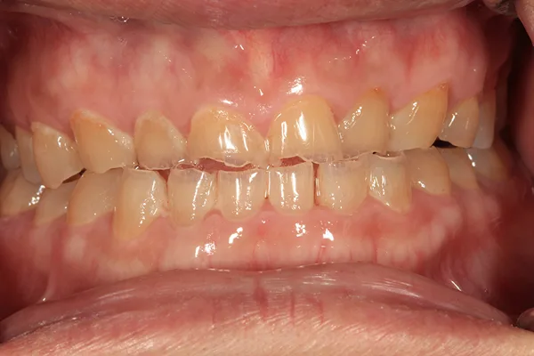 Front view of worn, short, uneven teeth before treatment