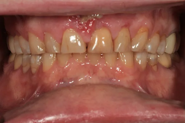 Front view of discolored, worn upper teeth and irritated gums before treatment
