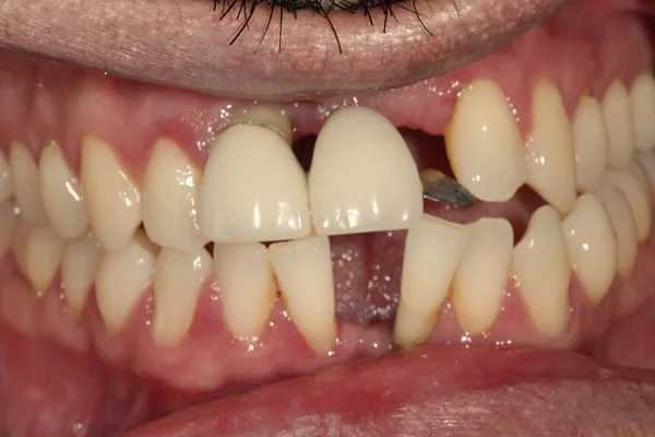 Front view of teeth before treatment, with missing upper teeth and gaps