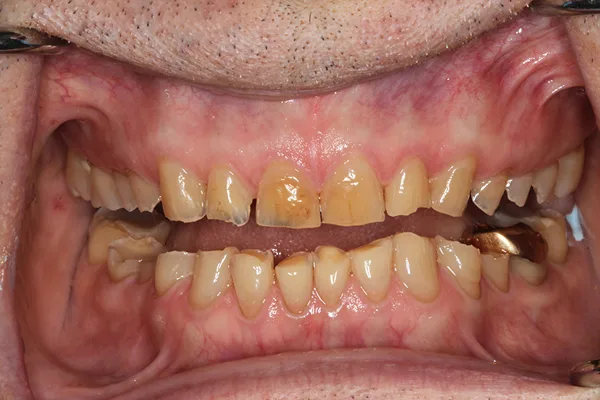 Front view of stained, worn and damaged teeth before treatment