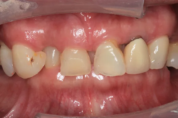 Front view of worn, uneven upper teeth with gaps before treatment