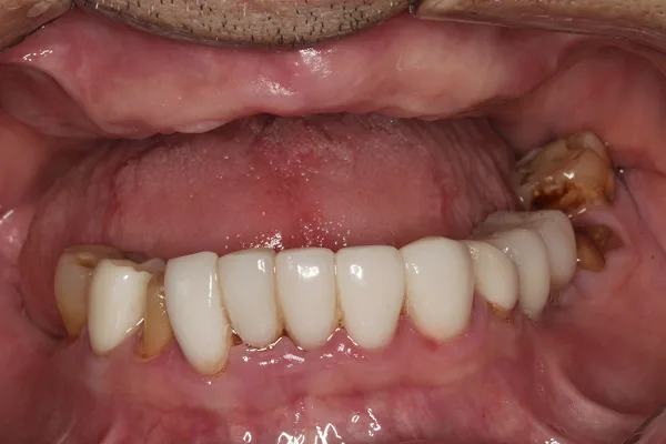 Open mouth before treatment, with no upper teeth and a row of lower teeth