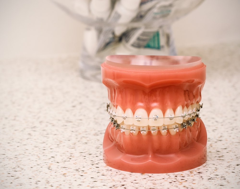 Dental model showing teeth with metal braces — orthodontic care for children and teens at Plaza Pointe Dental Specialists