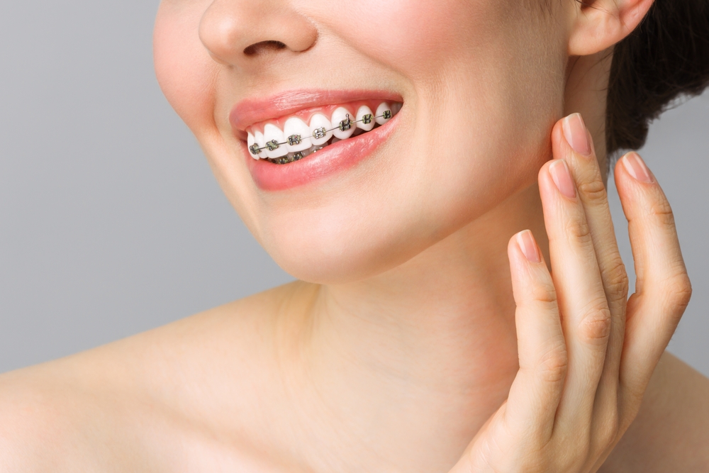 Woman smiling with traditional metal braces — orthodontic treatment at Plaza Pointe Dental Specialists, Mukilteo, WA