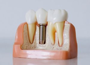 dental implants near you